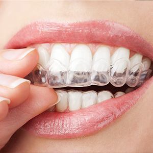 Cosmetic Dentist in Naperville